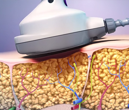 Video of how UltraShape ultrasound destroys belly fat